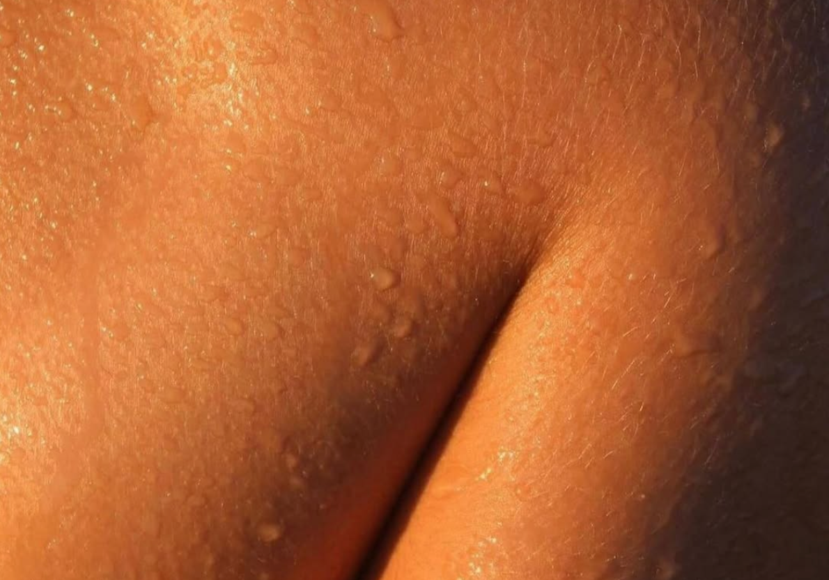 TERLEME VE VÜCUT KOKUSU